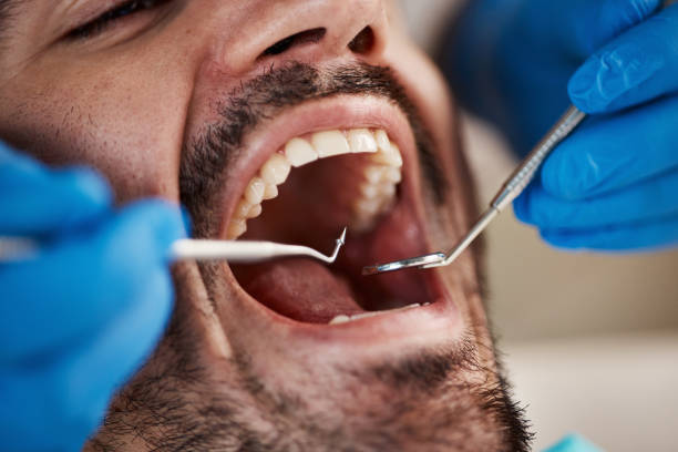 Best Broken or Cracked Tooth Emergency Dentist in Burtonsville, MD